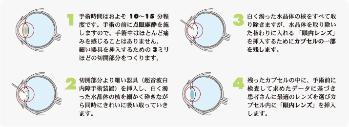 超音波白内障手術 説明